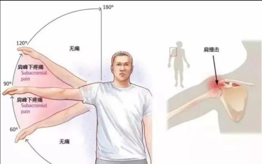 肩峰下撞击会引起什么症状,肩峰撞击导致手臂抬起来疼