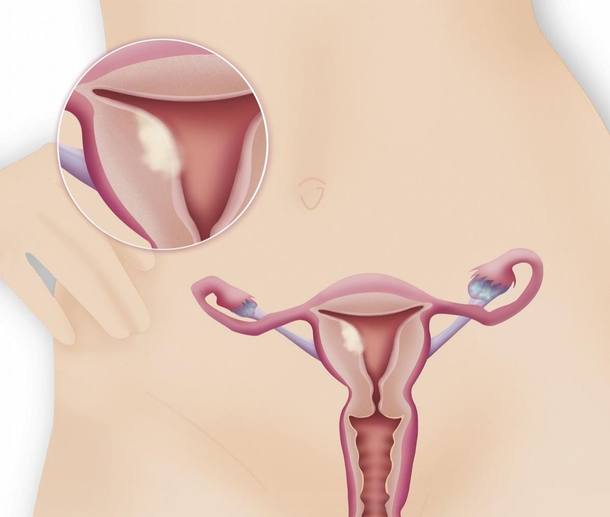 宫颈粘连导致痛经有什么危害吗,宫颈粘连的痛经怎么办