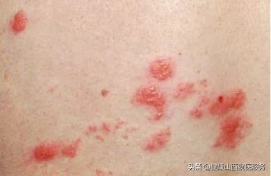 腰部红肿瘙痒起水泡,腰部起小红疙瘩特别痒如何治疗