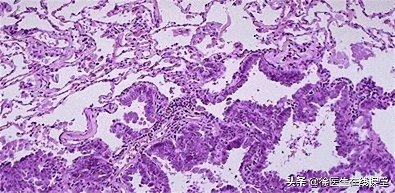 支气管哮喘治疗的5级阶梯治疗图,支气管哮喘分级和治疗