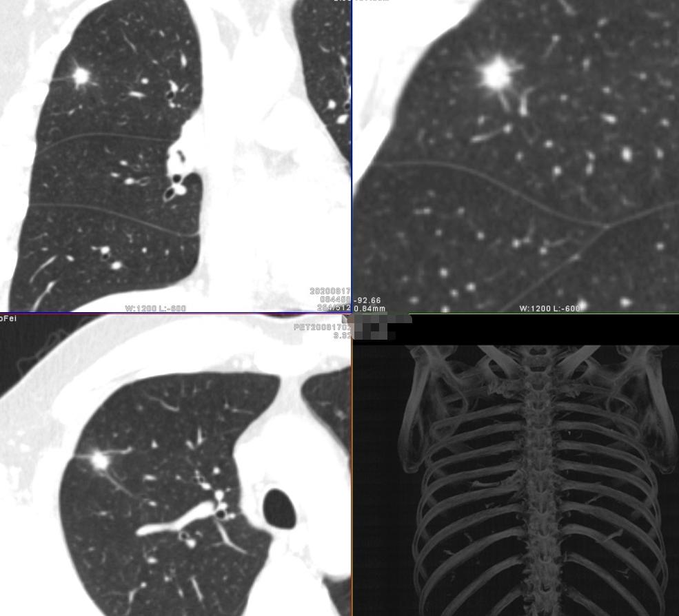 9mm肺结节实性结节良性几率多大,良性肺结节生长速度