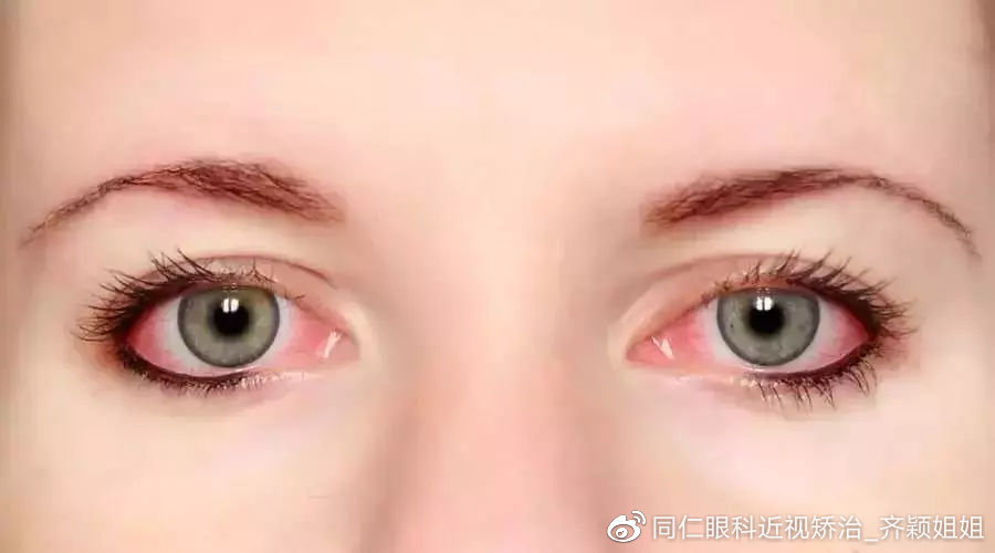 眼病角膜炎和结膜炎症状有何不同,结膜炎角膜炎眼睛为什么会反复红