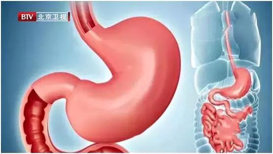 胃部肠道癌变治疗方案,胃里有肠细胞是怎么回事