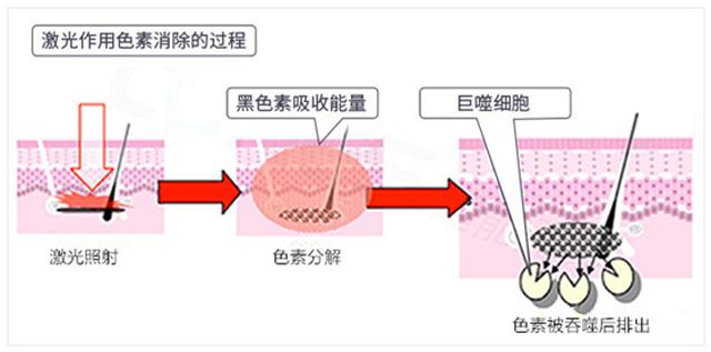激光美容到底效果如何,激光美容的利和弊是什么