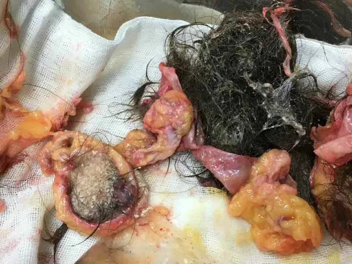 38岁女子盆腔长出了毛发和骨骼,这是一种什么怪病?