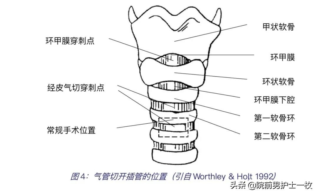 干货：气管切开术及护理措施