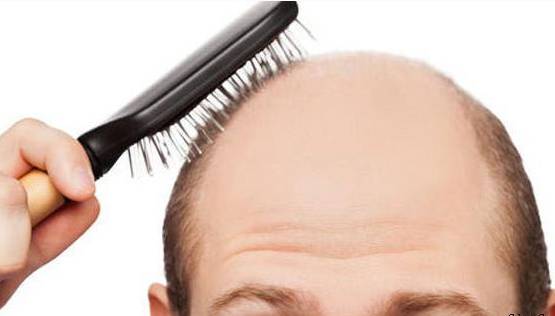 头顶后脑勺大面积脱发还能植发吗,男士大面积植发7个月