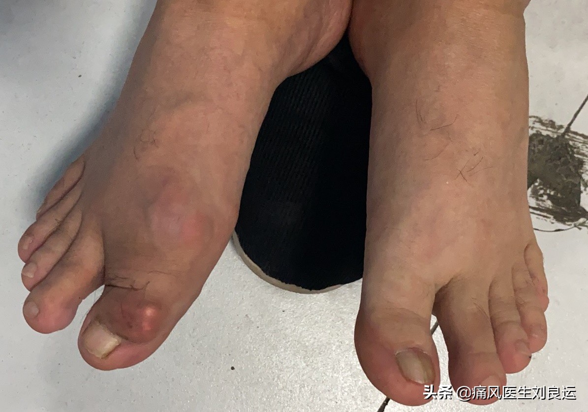 痛风能否真正根治,痛风病可以彻底治疗好吗