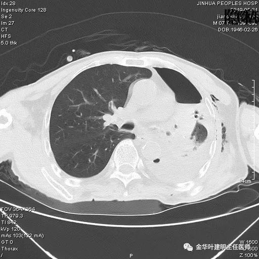 手术引起乳糜胸,有没有做了肺结节手术后是误诊的