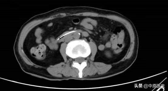 女子用洁厕灵中毒,因抑郁症误服洁厕灵算工伤吗