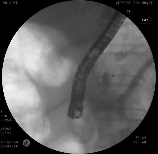 老年人肠梗阻疼痛难忍,老年人腹部剧痛
