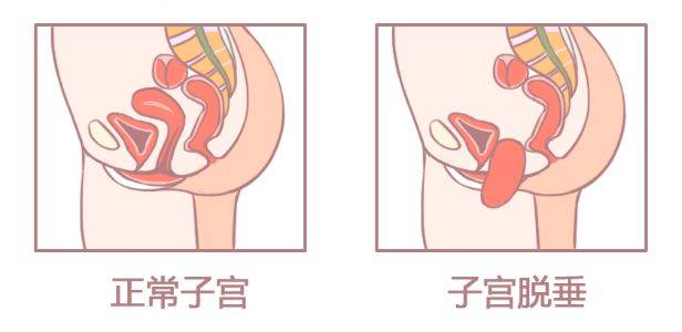 子宫脱垂做什么运动,子宫脱垂还能怀孕吗