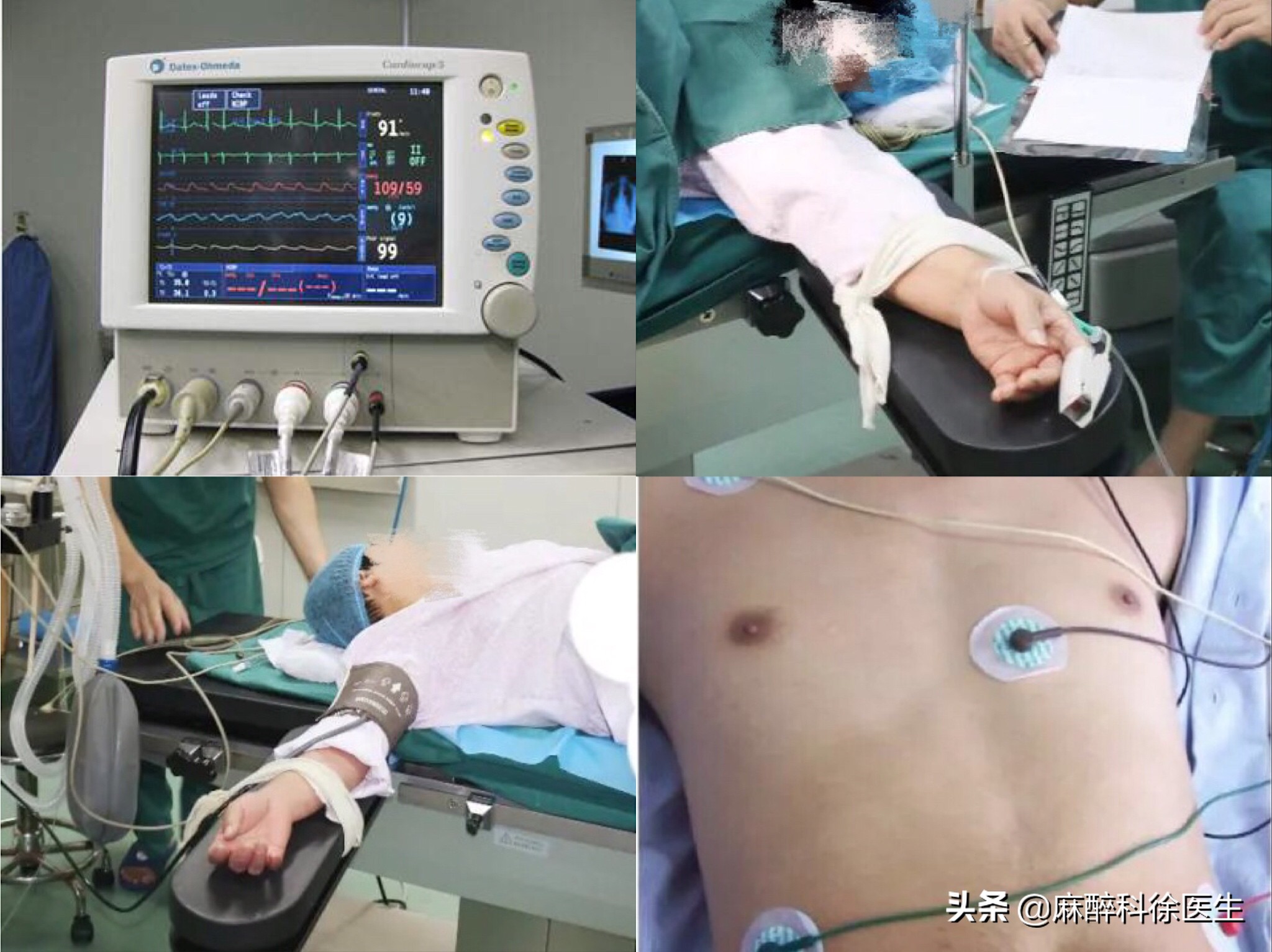 麻醉就是麻醉什么感觉,麻醉师讲的是什么