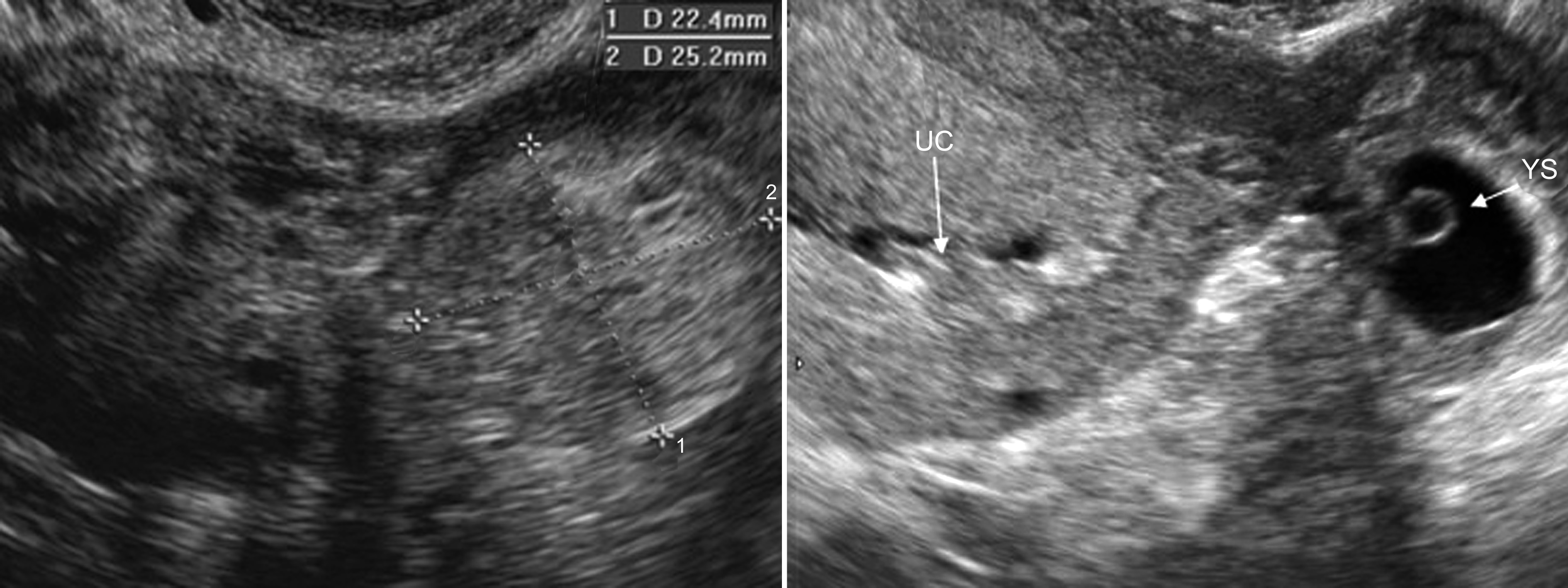 无痛输卵管超声造影全过程图解,输卵管间质部妊娠超声图像