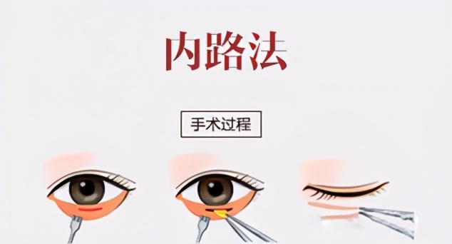 如何分清楚卧蚕泪沟眼袋黑眼圈,眼袋卧蚕和泪沟有什么区别