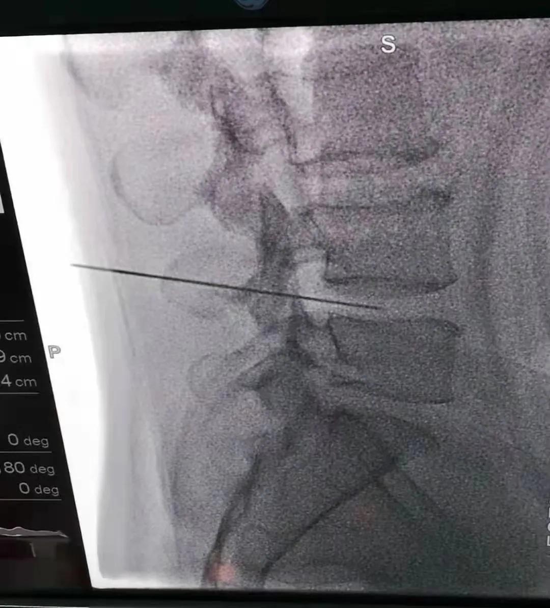 「你是我的眼」——记超声引导下精准疼痛治疗