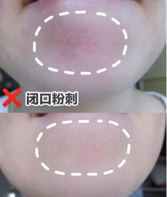 纯露中的反“孔”精英,去除闭口收缩毛孔,吃土女孩也用得起