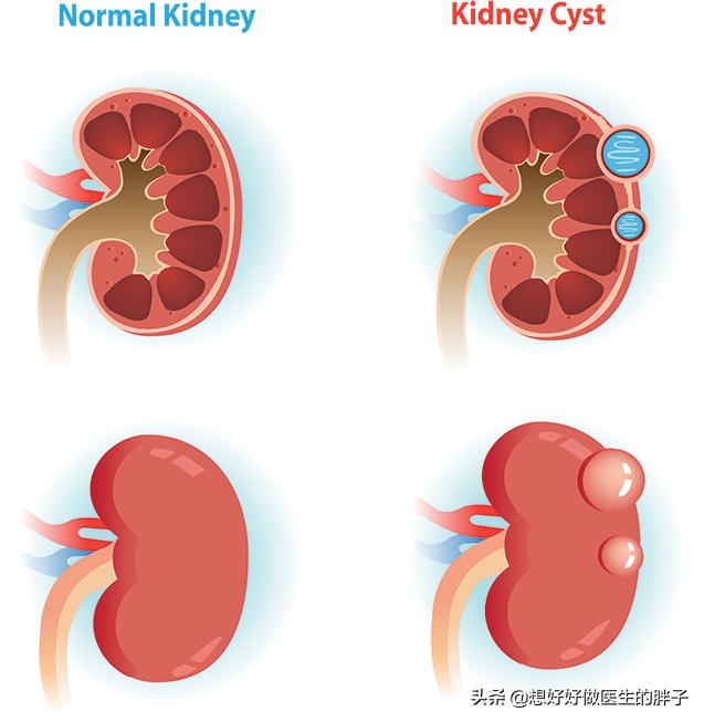 辟谣囊肿手术,得了囊肿必须切除么