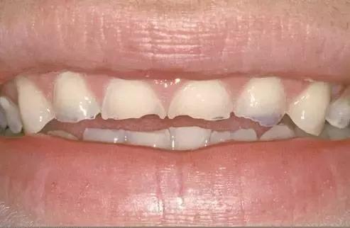 牙釉质为什么会脱落,牙釉质为啥会掉