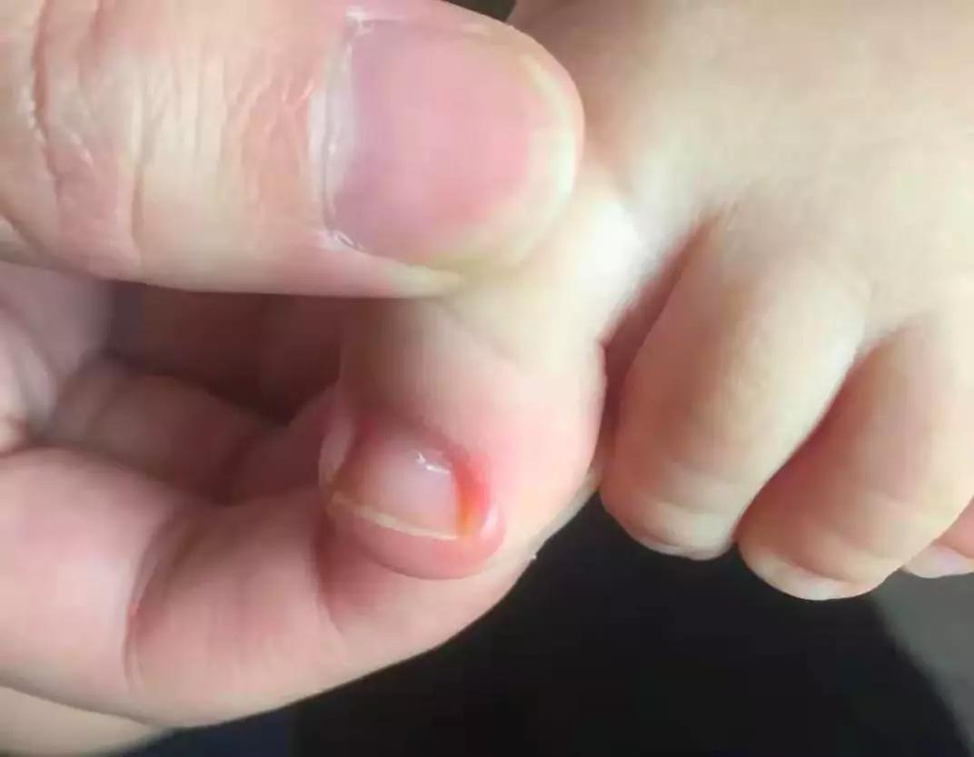 宝宝脚趾甲往肉里长怎么办,宝宝脚趾甲往肉里长怎么干预