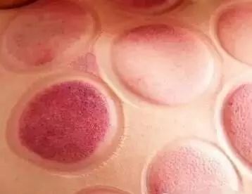 拔罐时出现罐印红是怎么回事,怎样快速消除拔罐留下的罐印