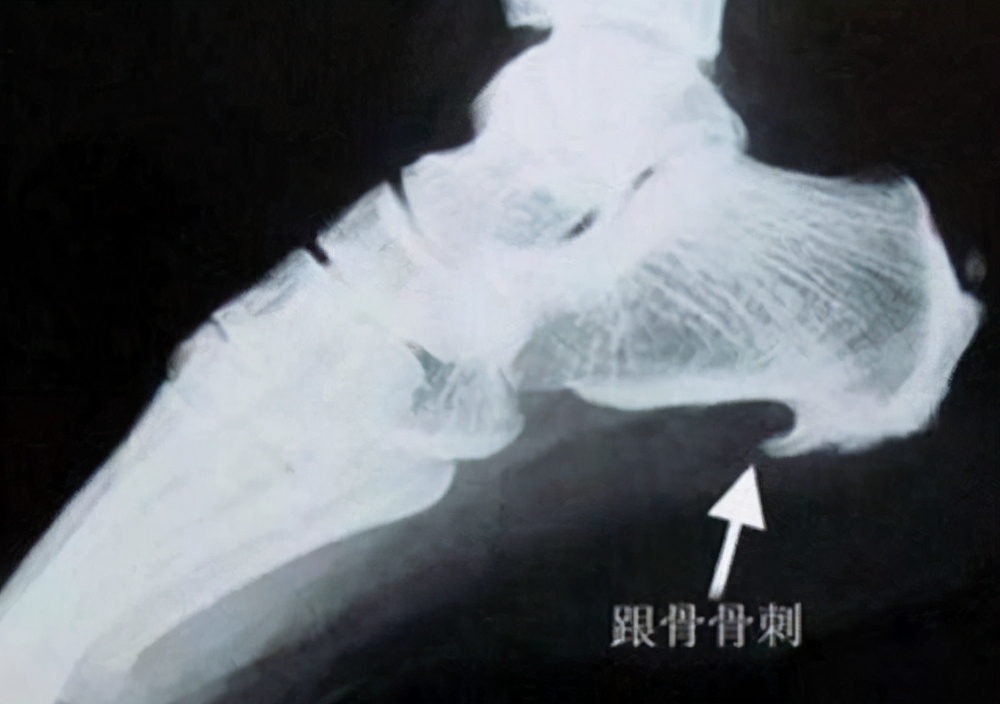 脚后跟骨刺一根筷子解决,脚后跟长骨刺是怎么回事