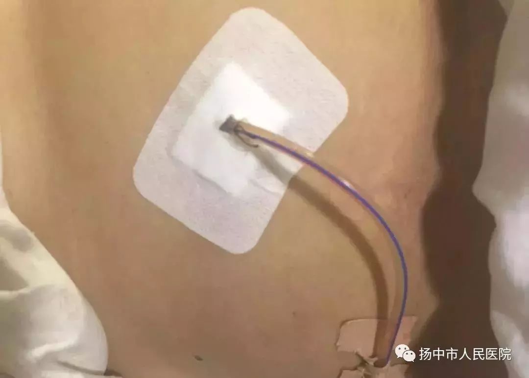 肝癌手术都需要插什么管子,肝癌术后为什么还有结节