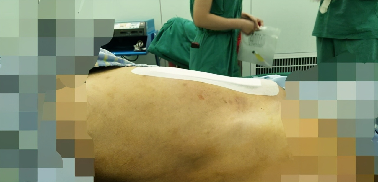 女子腹大如鼓竟是罕见病作怪,女子腹中生巨瘤肚皮肿胀如孕妇