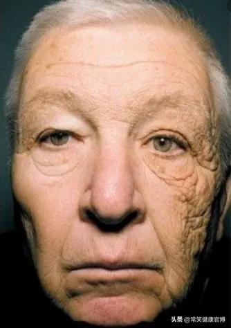 右脸比左脸小30岁后不好吗,左脸比右脸突出是什么原因