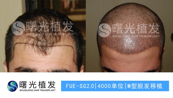 合肥脱发植发,合肥曙光植发