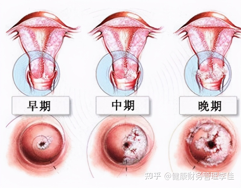 宫颈癌买哪种保险可以理赔,宫颈癌前病变属于重大理赔范围吗