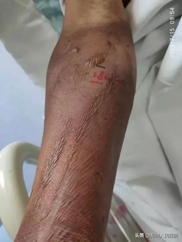 “砰”的一声，我把自己送进了ICU—“一位电击伤患者的自述”