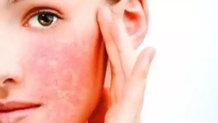 暴晒后有红血丝怎么办,晒红后怎么能快速修复