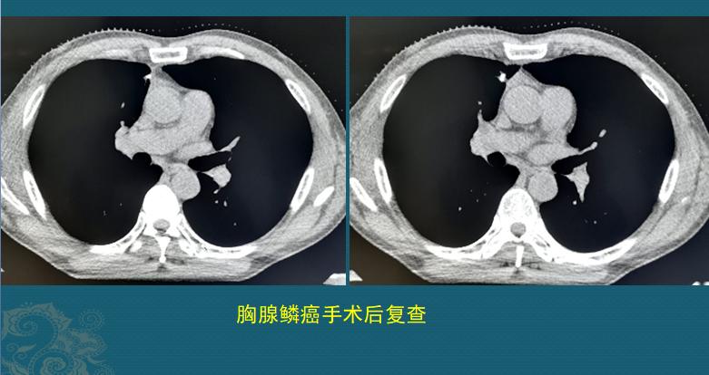 为什么每年体检还会查出癌症晚期,年年体检正常却被诊断为癌症晚期