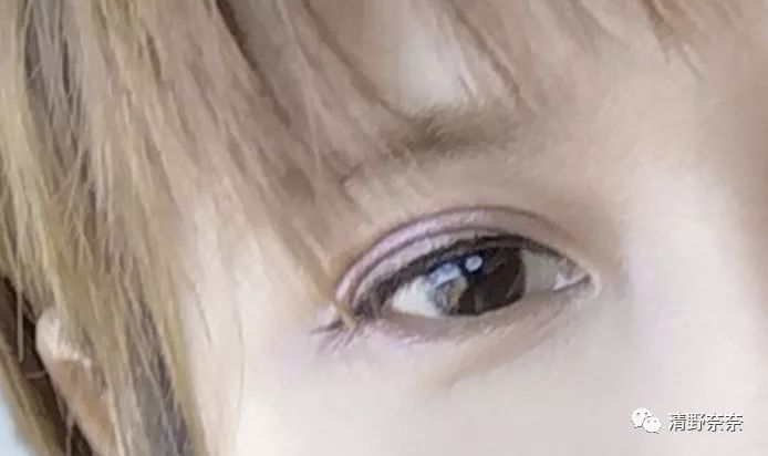 改善法令纹和川字纹抬头纹医美,祛除法令纹鱼尾纹最佳医美方法