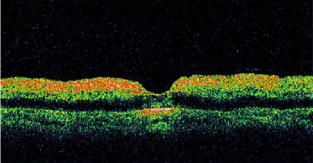 黄斑视网膜病变,黄斑病变会导致夜间视力下降