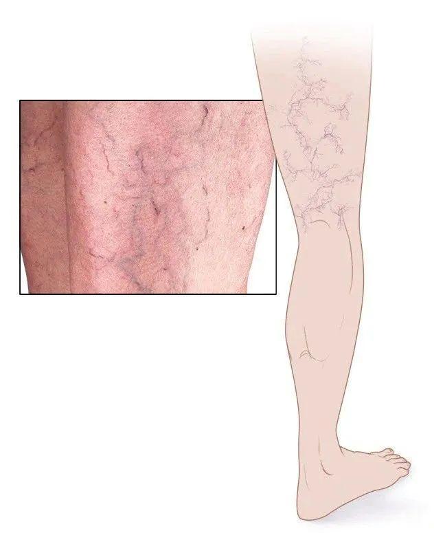 静脉曲张的危害什么是静脉曲张,预防静脉曲张穿多久静脉曲张袜