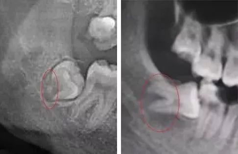 拔智齿痛到怀疑人生,拔了智齿痛的怀疑人生