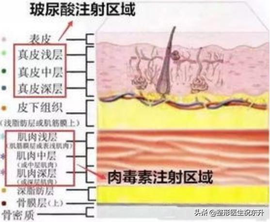 刚打完瘦脸针医生就让冰敷了,瘦脸针和玻尿酸一起打影响效果吗