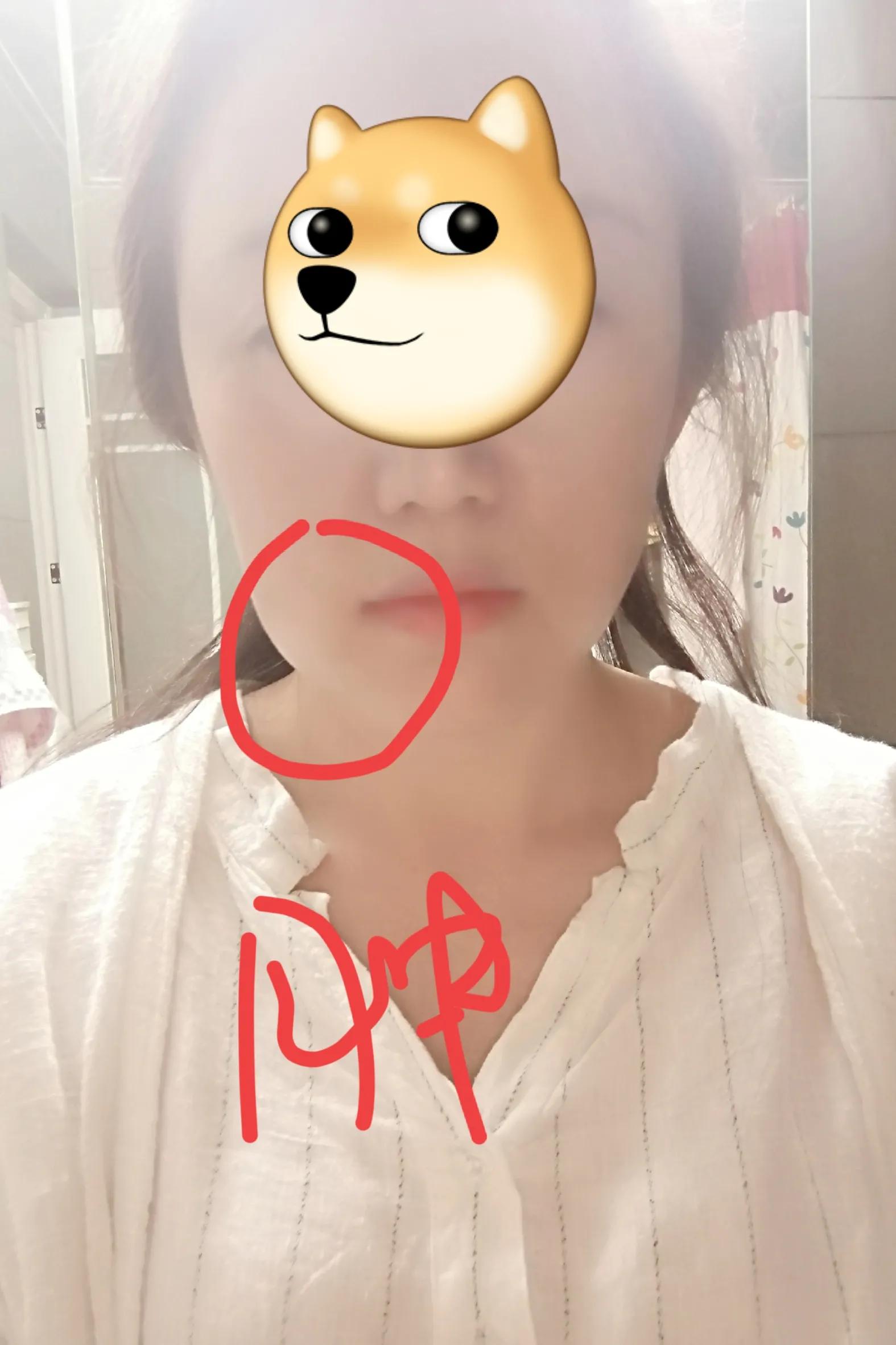 亲身经历了拔尽头牙,两颗门牙种植牙的惨痛经历