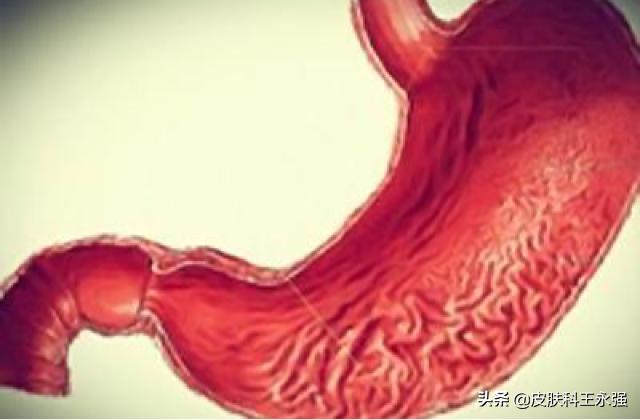 慢性萎缩性胃炎贫血原因,萎缩性胃炎贫血是缺铁性贫血吗