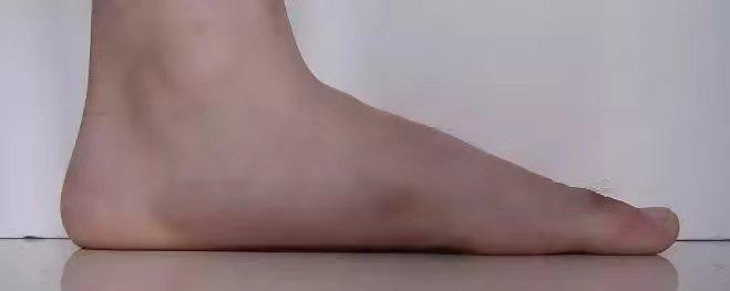 西安治疗扁平足最好的医院,扁平足拇指外翻的治疗方法