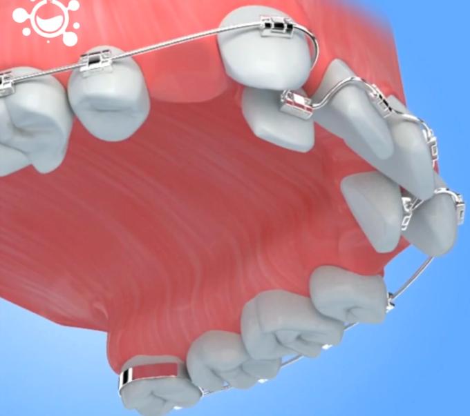 牙齿拥挤畸形矫正哪种牙套比较好,牙齿拥挤不齐隐形矫正要多少钱