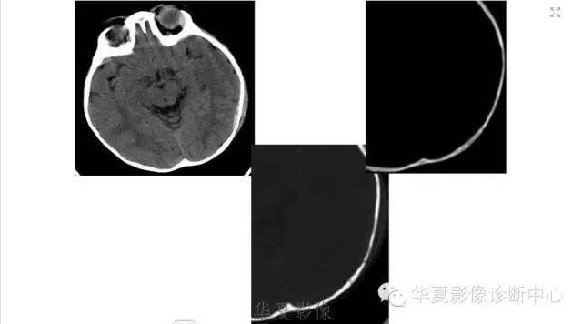 一文读懂颅内胆脂瘤,一文看懂背后的真相