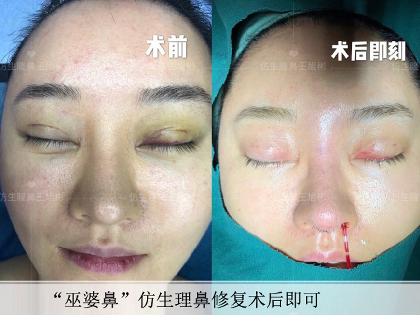 缩鼻翼可以改善鼻翼下垂吗,鼻翼肥大之鼻翼缩小术你见过吗