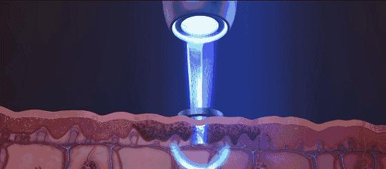 医美皮肤科医生介绍,医美小知识光子嫩肤