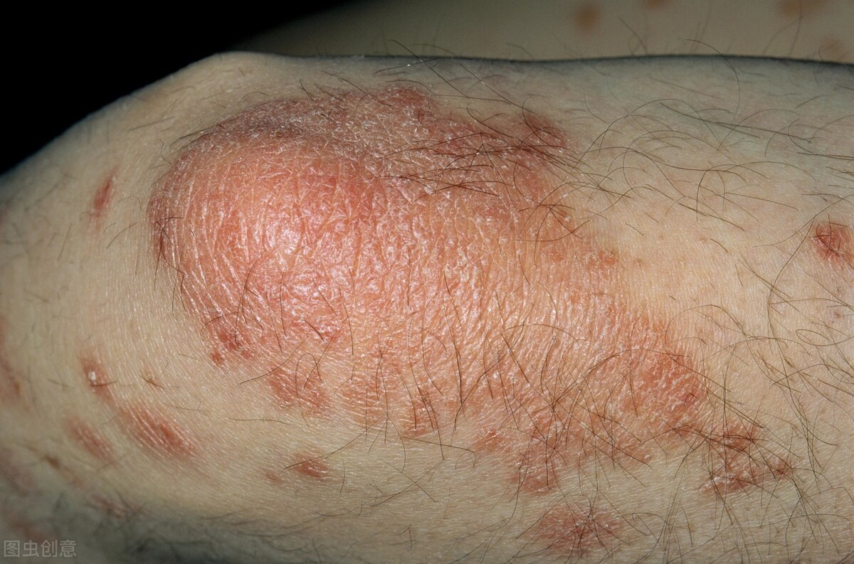 银屑病不太严重怎么治疗,银屑病怎么才算治好