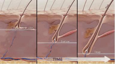 去头屑去螨虫哪个洗发水最有效,去头屑去螨虫用哪个洗发水最有效