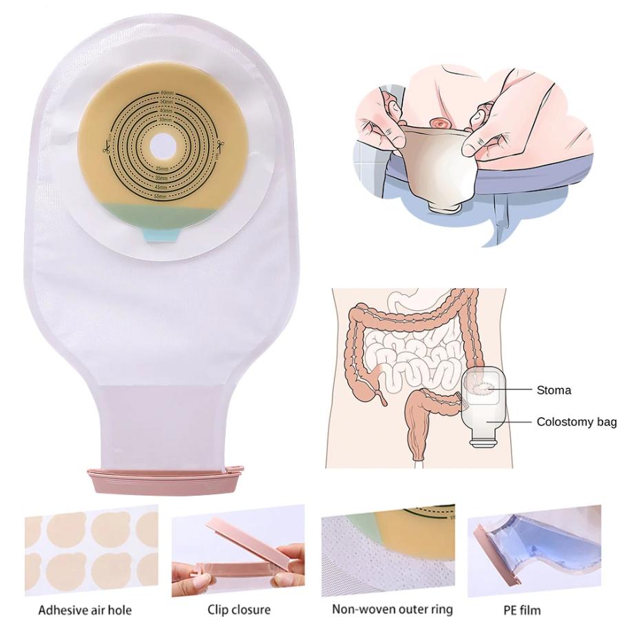 直肠癌“保肛”，你必须知道的知识