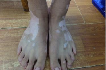 小孩脚部白癜风,小孩湿疹后擦药导致白癜风